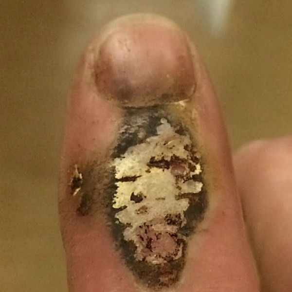 Finger burn before treatment