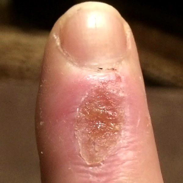 Finger burn during recovery