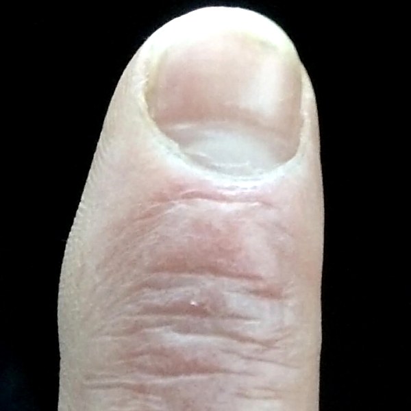 Finger burn after recovery