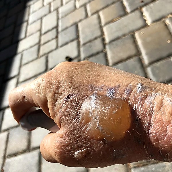 Hand burn before treatment