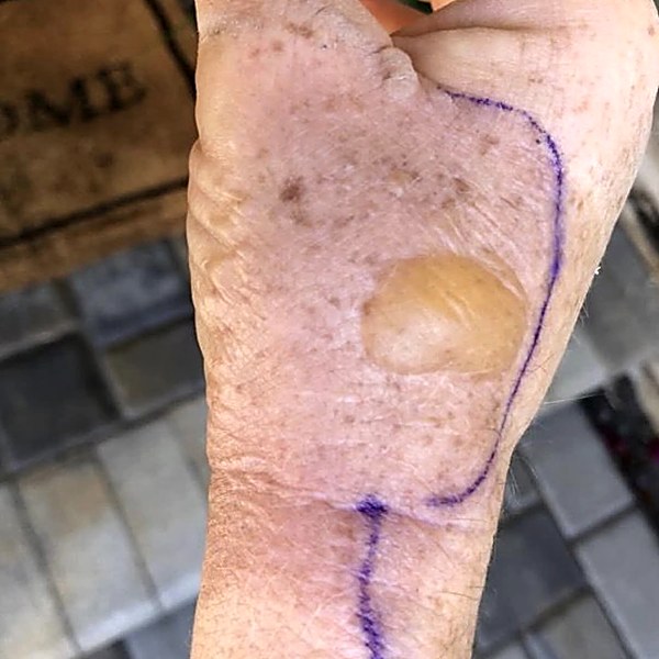 Wrist blister before treatment