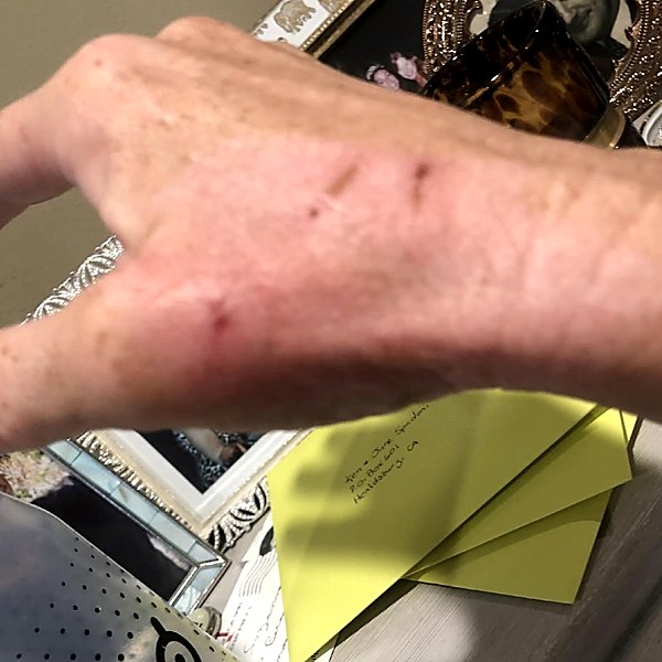 Hand burn after recovery