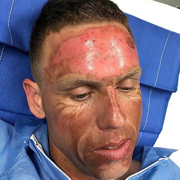 Facial burn before treatment