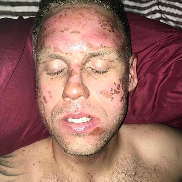 Facial burn early recovery