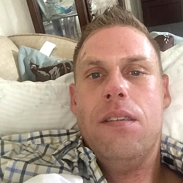 Facial burn continued recovery