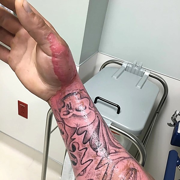 Forearm burn before treatment