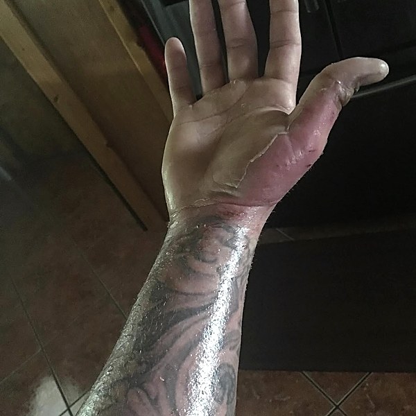Forearm burn after recovery