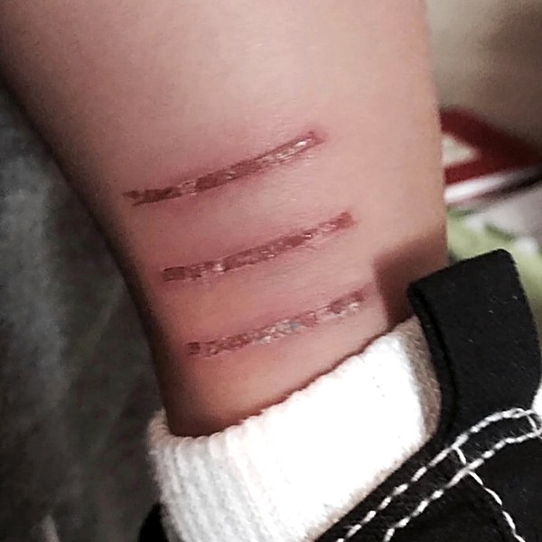 Arm burn before treatment