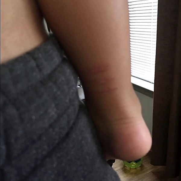 Arm burn during recovery