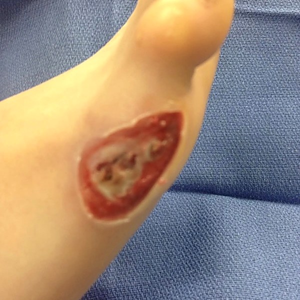 Foot burn before treatment