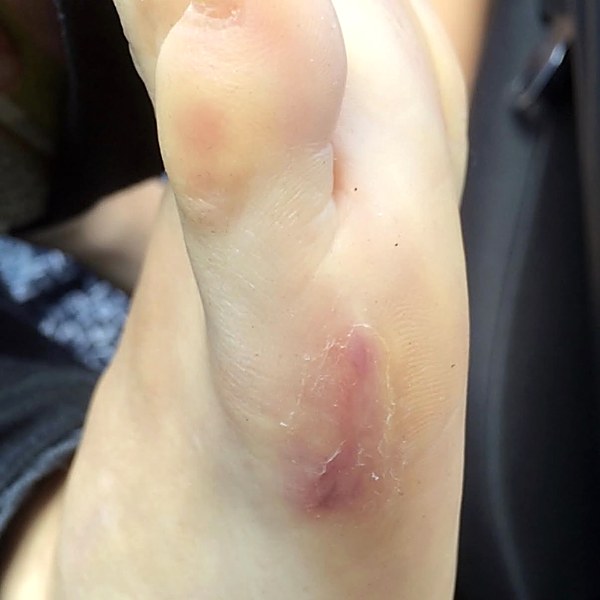Foot burn after recovery